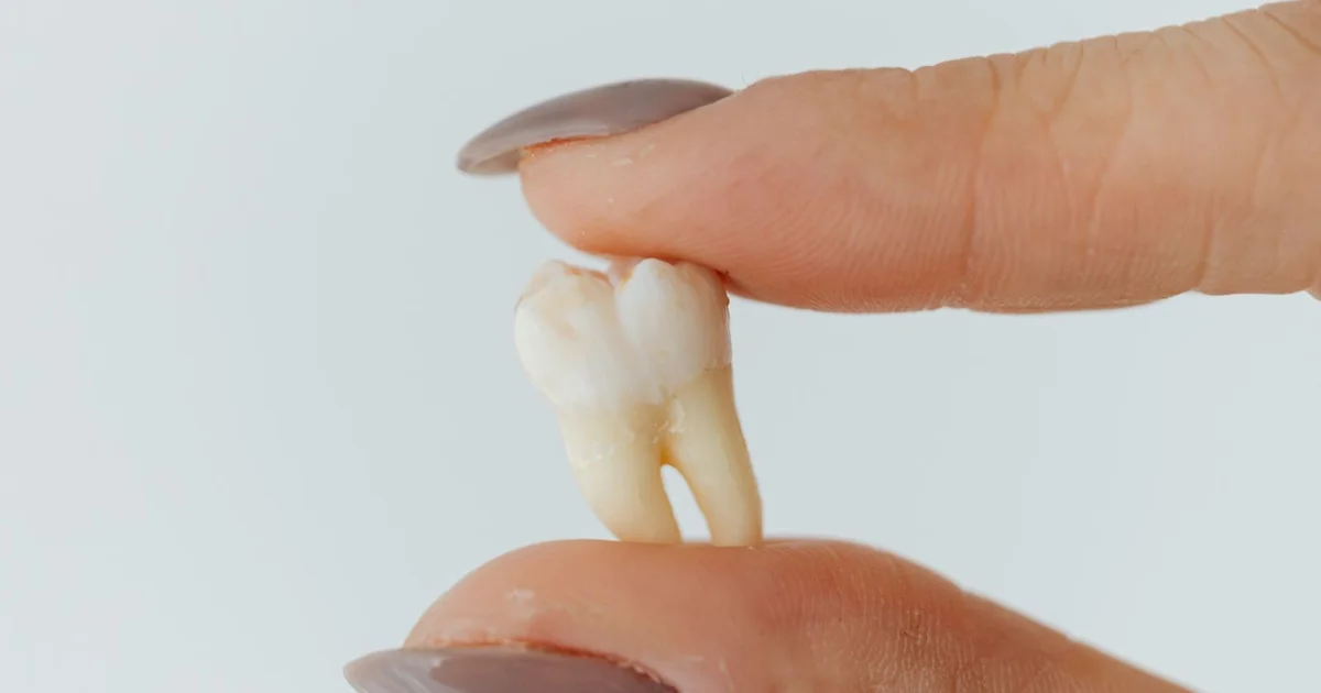 How Much Does a Tooth Extraction Cost in Australia? (2026 Prices)