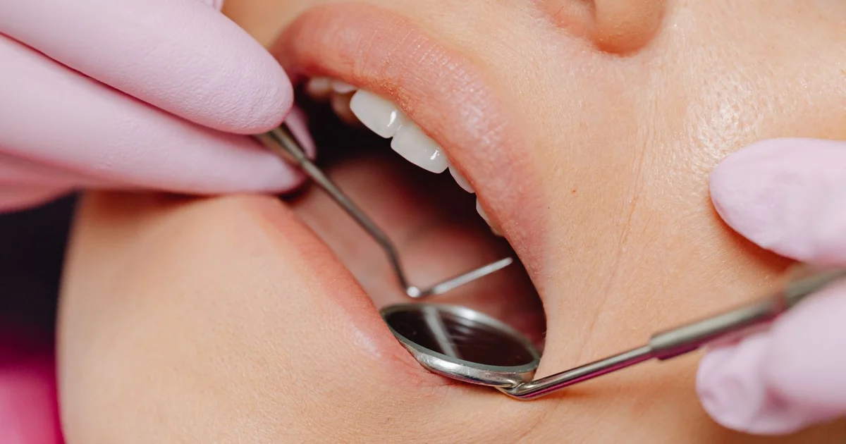 How Much Does a Tooth Filling Cost in Australia? (2026 Prices)